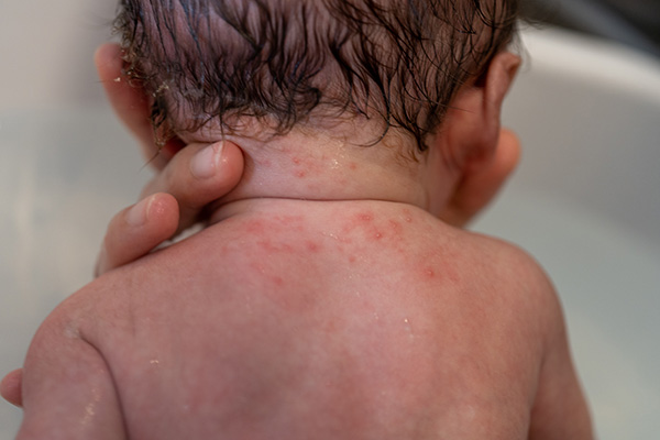 赤ちゃんの肌荒れトラブルの原因